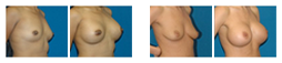 breast-augmentation.png