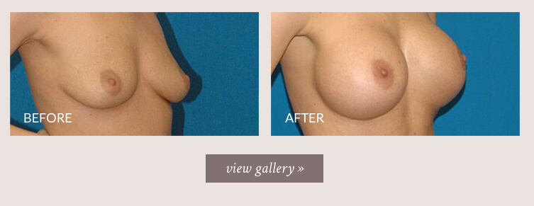 breast-implant-gallery.jpg