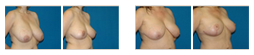 breast-reduction.png