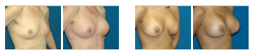 breast-revision.png