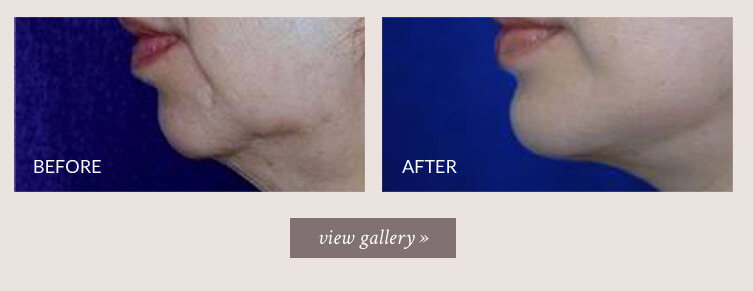 chin-implant-gallery.jpg