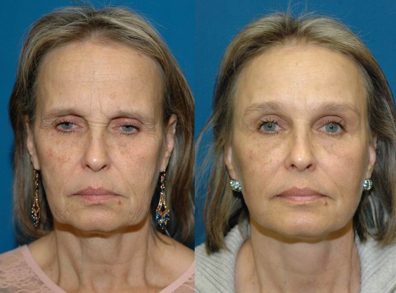 forehead_reduction01.jpg forehead_reduction01.jpg