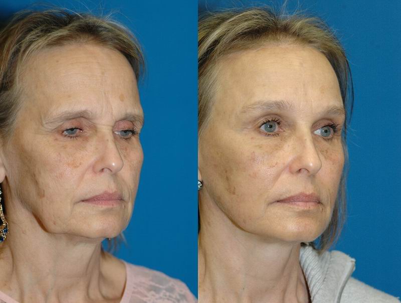 forehead_reduction02.jpg forehead_reduction02.jpg