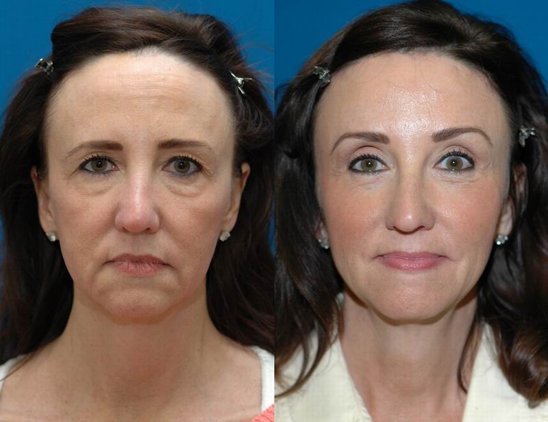 forehead_reduction03.jpg forehead_reduction03.jpg