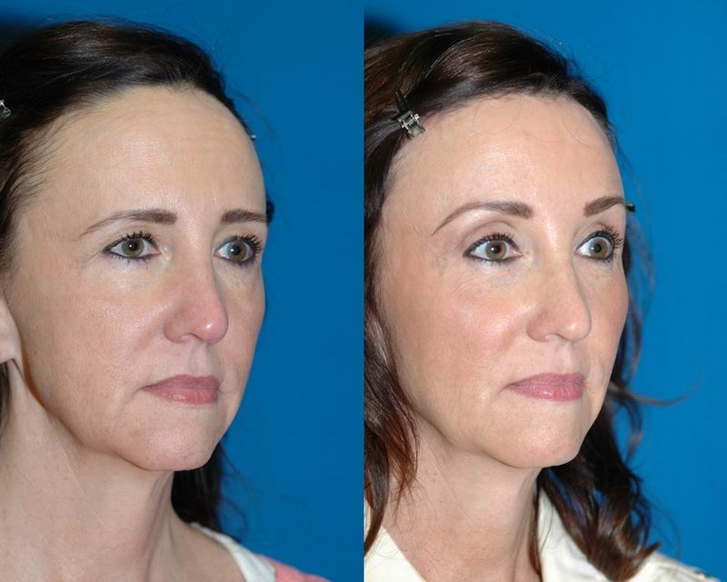 forehead_reduction04.jpg forehead_reduction04.jpg