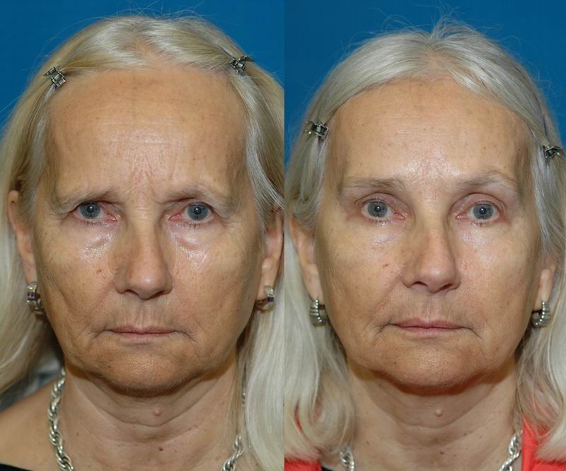 forehead_reduction12.jpg forehead_reduction12.jpg