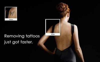 R20 method allows fast treatment of tattoos