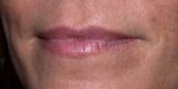 Before restylane lip augmentation