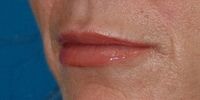 After lip augmentation using Gore-Tex