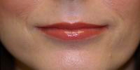 After lip augmentation with fat, face lift