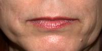 Before lip augmentation with fat, face lift