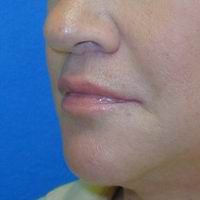 After lip lift, corner of the mouth lift, and lip augmentation with fat