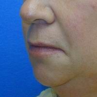 Before lip lift, corner of the mouth lift, and lip augmentation with fat