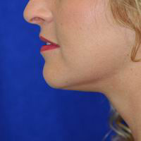 After chin and neck liposuction