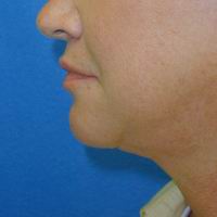 After neck liposuction, chin augmentation, upper lip lift, upper lip augmentation