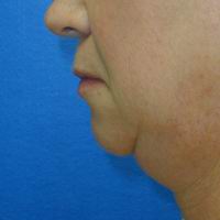 Before neck liposuction, chin augmentation, upper lip lift, upper lip augmentation