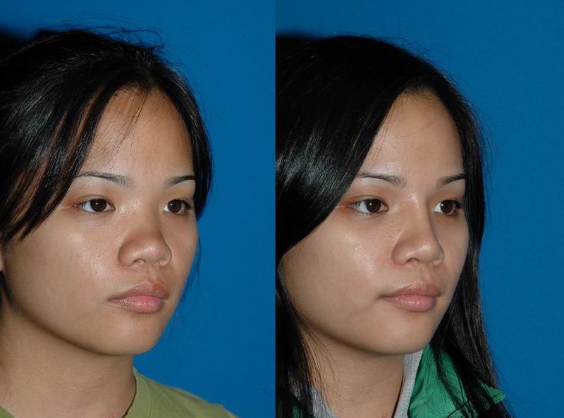 asian nose job before and after