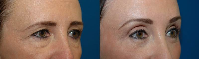 Brow Lift Seattle Forehead Lift Specialist