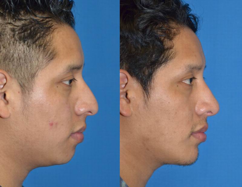 pointy chin implant
