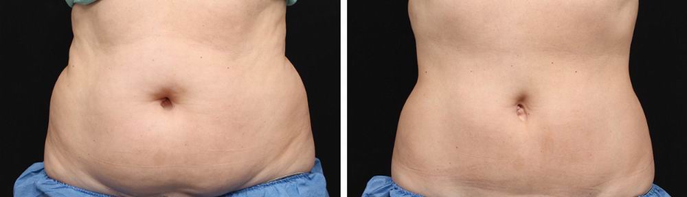 coolsculpting_before_after_02.jpg