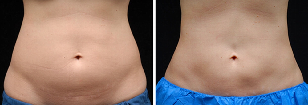 coolsculpting_before_after_04a.jpg