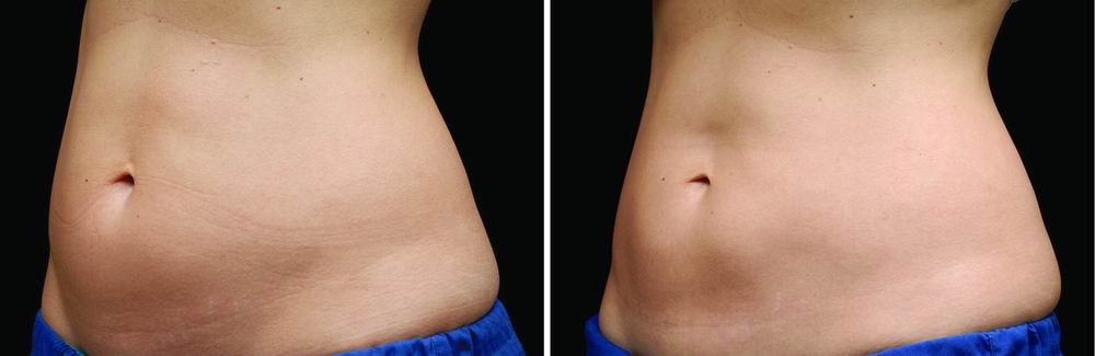 coolsculpting_before_after_04b.jpg