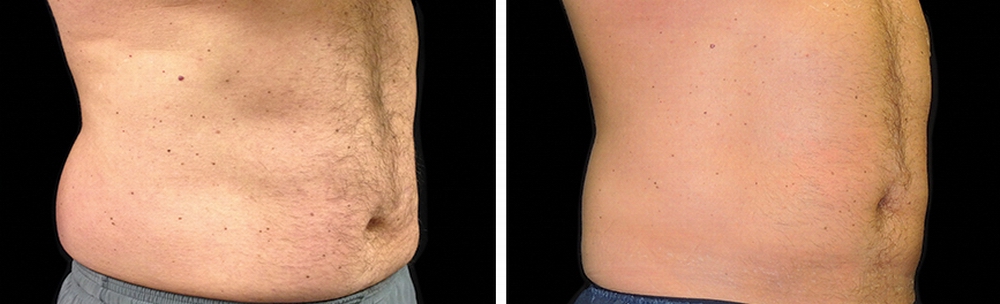 coolsculpting_before_after_05.jpg