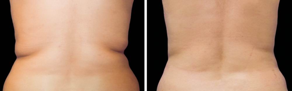 coolsculpting_before_after_06.jpg