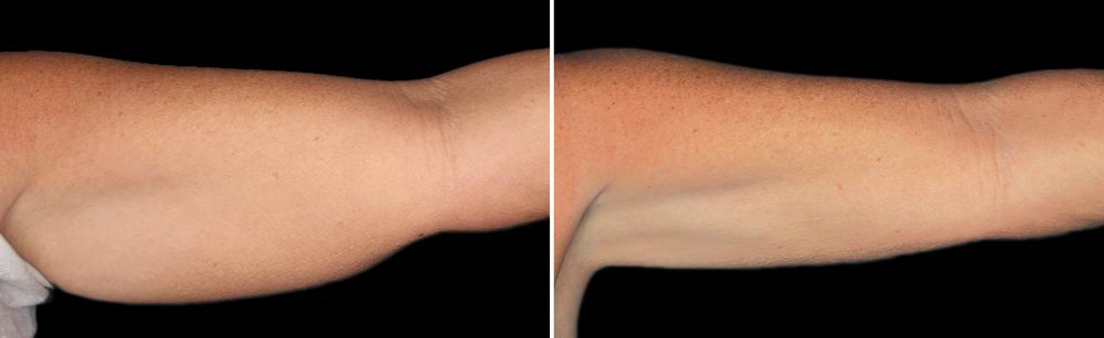 coolsculpting_before_after_09.jpg