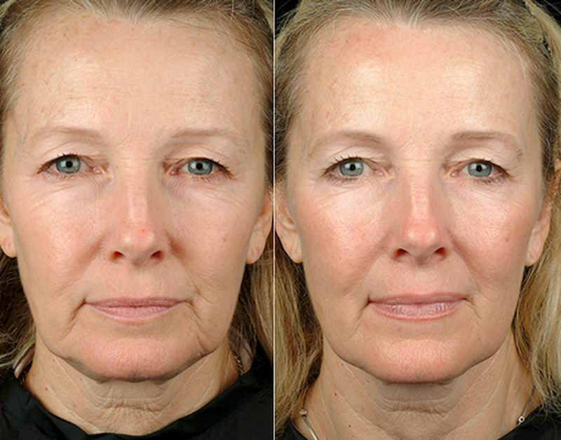 Thermage Bellevue| Thermage FLX Skin Tightening | Naficy
