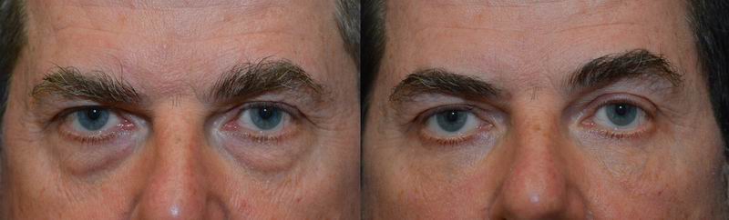 Clifford Eye Bag Protocol: Best Non-Surgical Eye Bag Removal?