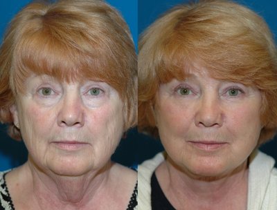 Face Lift Seattle | Face Lift Specialist