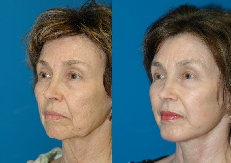 Face Lift Seattle  Face Lift Specialist