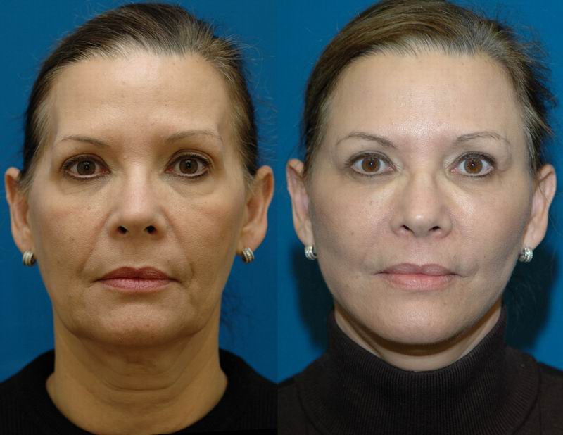 Face Lift Seattle  Face Lift Specialist