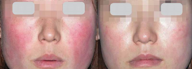 spider veins on face treatment at home
