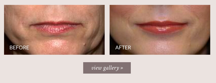 AirSculpt on LinkedIn: Achieving Fuller Lips: The Ultimate Guide to Lip  Augmentation
