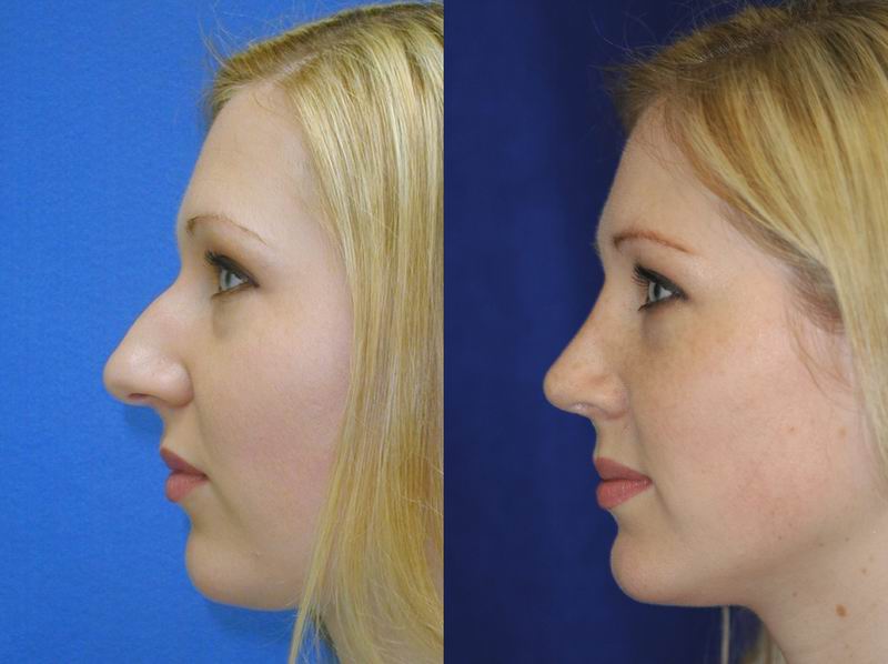 rhinoplasty hump nose surgery before primary plastic removal revision nasal bump hooked tip seattle dr procedure results face wide vary