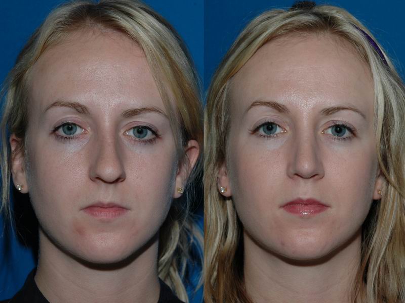 Ринопластика глаз фото до и после