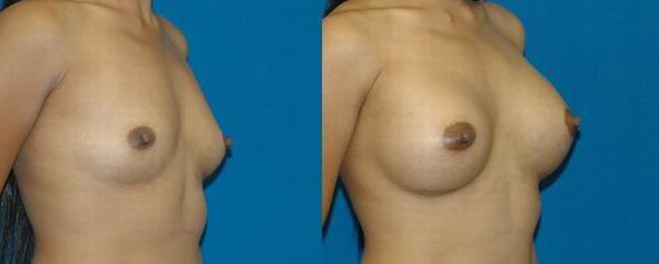 seattle_breast_implant01a.jpg