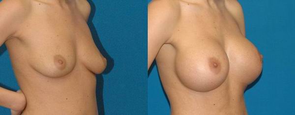 seattle_breast_implant02a.jpg