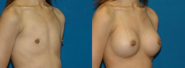 seattle_breast_implant13a.jpg