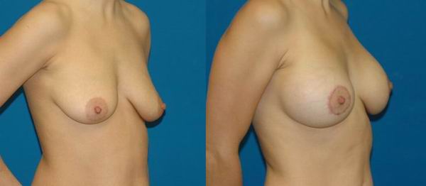 seattle_breast_implant18a.jpg